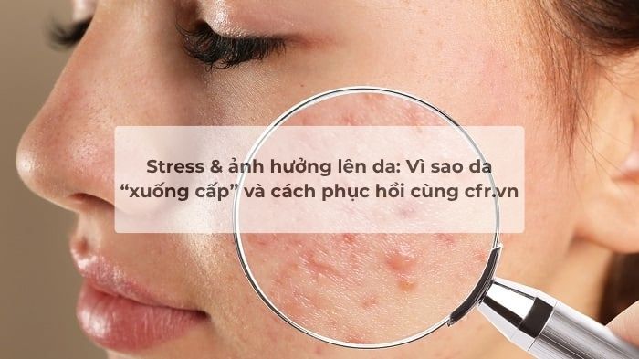 Stress & ảnh hưởng lên da: Vì sao da “xuống cấp” và cách phục hồi cùng cfr.vn