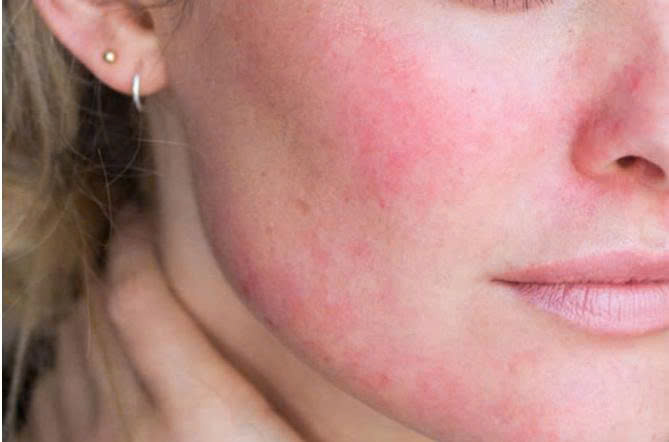 Da đỏ – kích ứng: phải làm gì để phục hồi nhanh và an toàn cùng cfr.vn