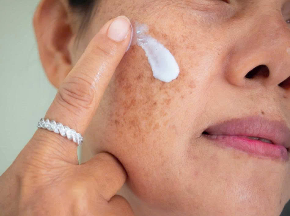 Trị nám an toàn: Giải pháp làm mờ nám bền vững cùng cfr.vn