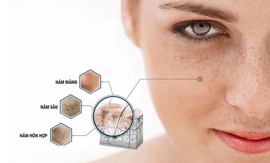 Trị nám an toàn: Giải pháp làm mờ nám bền vững cùng cfr.vn