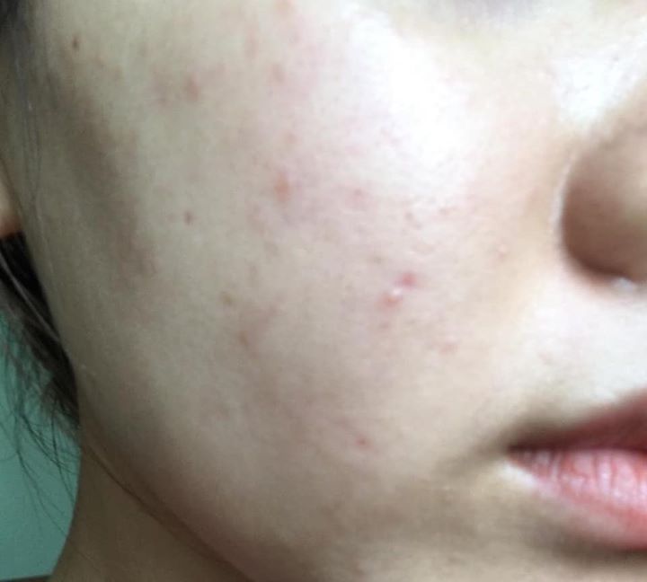 Giải pháp trị mụn hiệu quả: Quy trình chăm sóc da giúp giảm mụn và phục hồi da khỏe mạnh