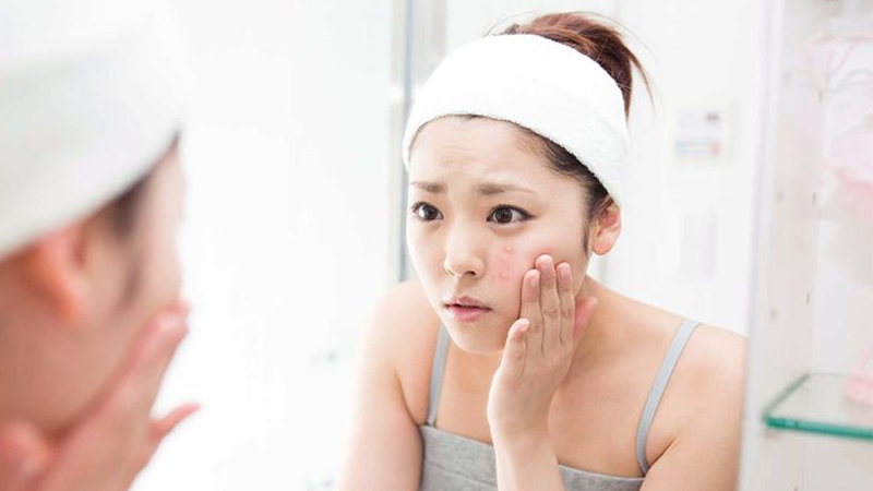 Nguyên Nhân Da Mụn Tái Phát: Vì Sao Mụn Quay Lại Và Cách Ngăn Ngừa Hiệu Quả