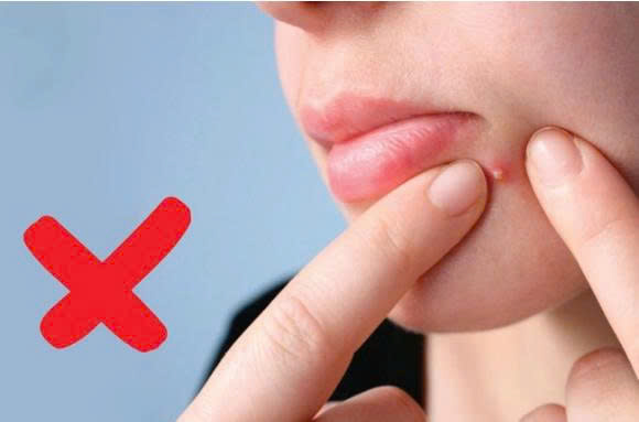 Nguyên Nhân Da Mụn Tái Phát: Vì Sao Mụn Quay Lại Và Cách Ngăn Ngừa Hiệu Quả