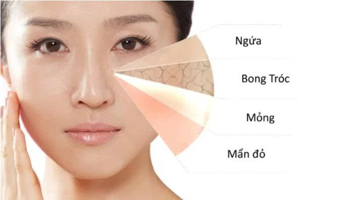 Routine cho da nhạy cảm: Quy trình chăm sóc da an toàn giúp giảm kích ứng